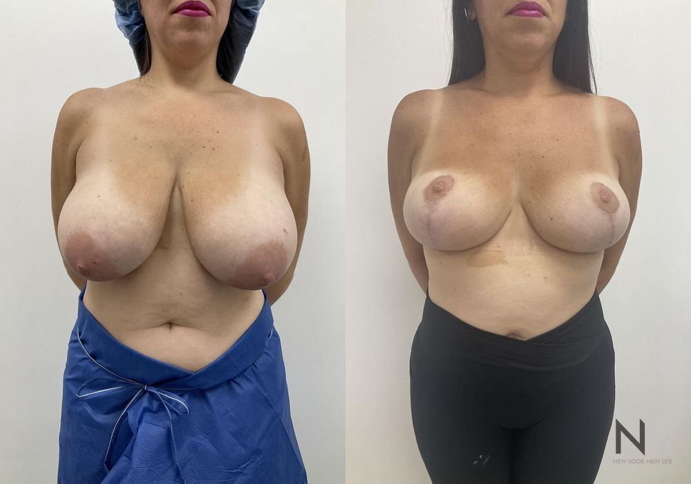 Breast Reduction - Thumbnail 4