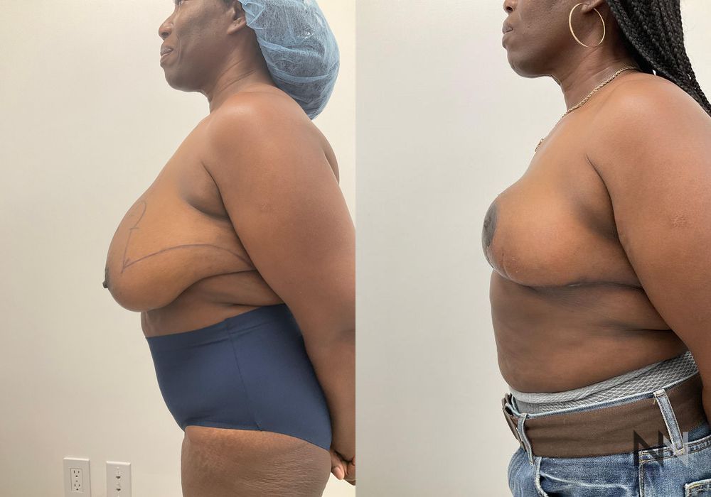 Breast Reduction - Thumbnail 3