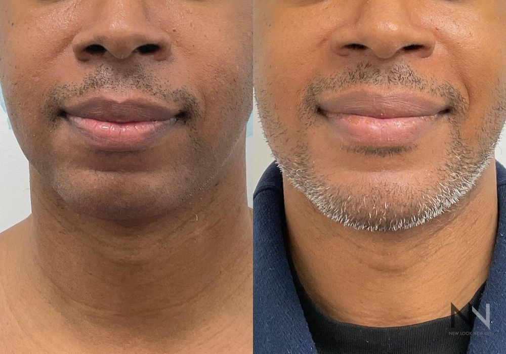 Chin Augmentation - Case 2141