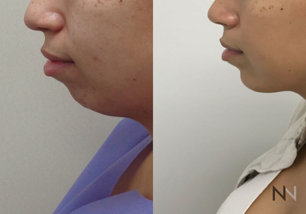 Chin Augmentation - Thumbnail 2