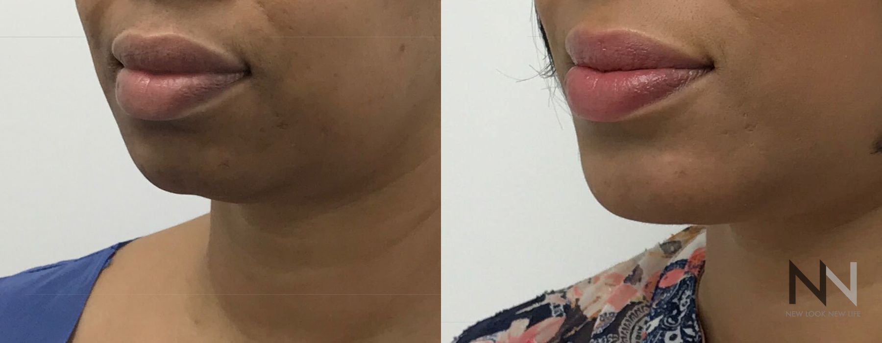 Chin Augmentation - Case 1955