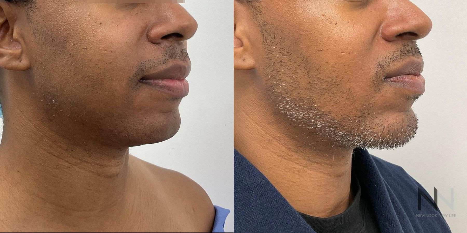 Submental liposuction showing improved jawline contour