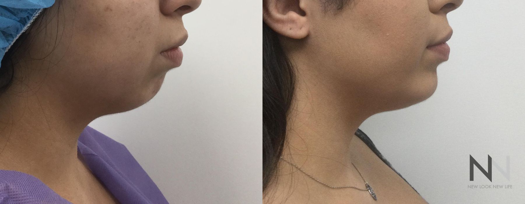 Chin Augmentation - Thumbnail 2