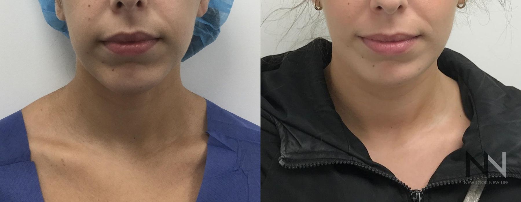 Chin Augmentation - Case 2143