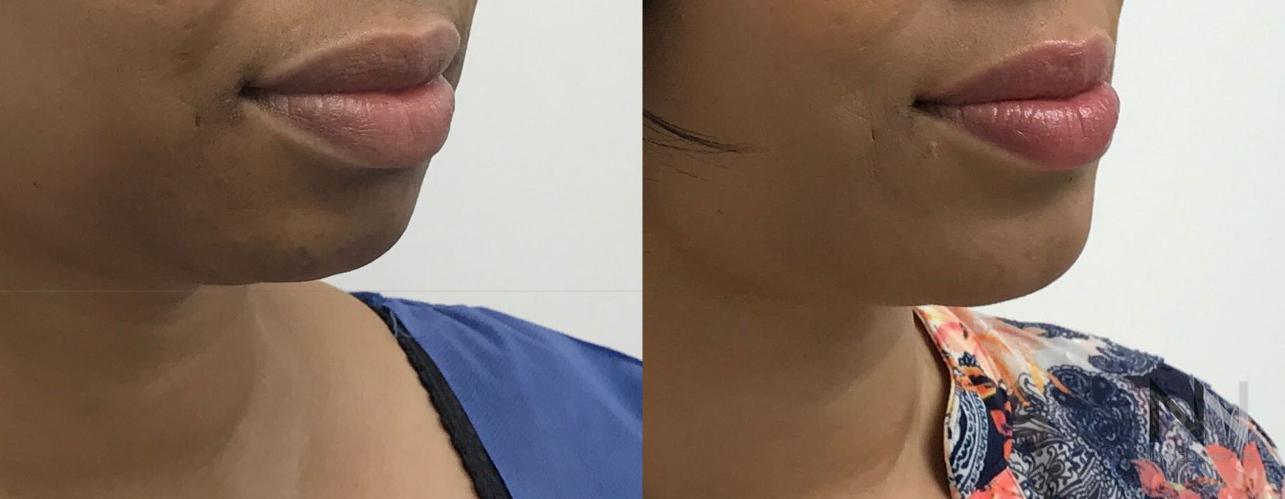 Chin Augmentation - Thumbnail 3