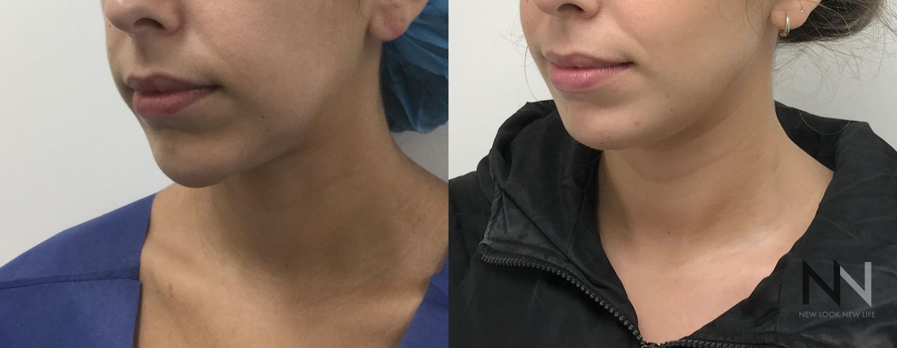 Chin Augmentation - Thumbnail 4