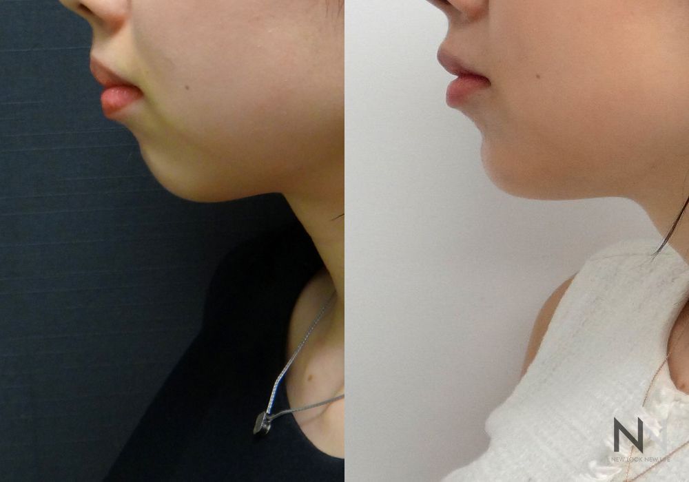 Chin Augmentation - Case 1954