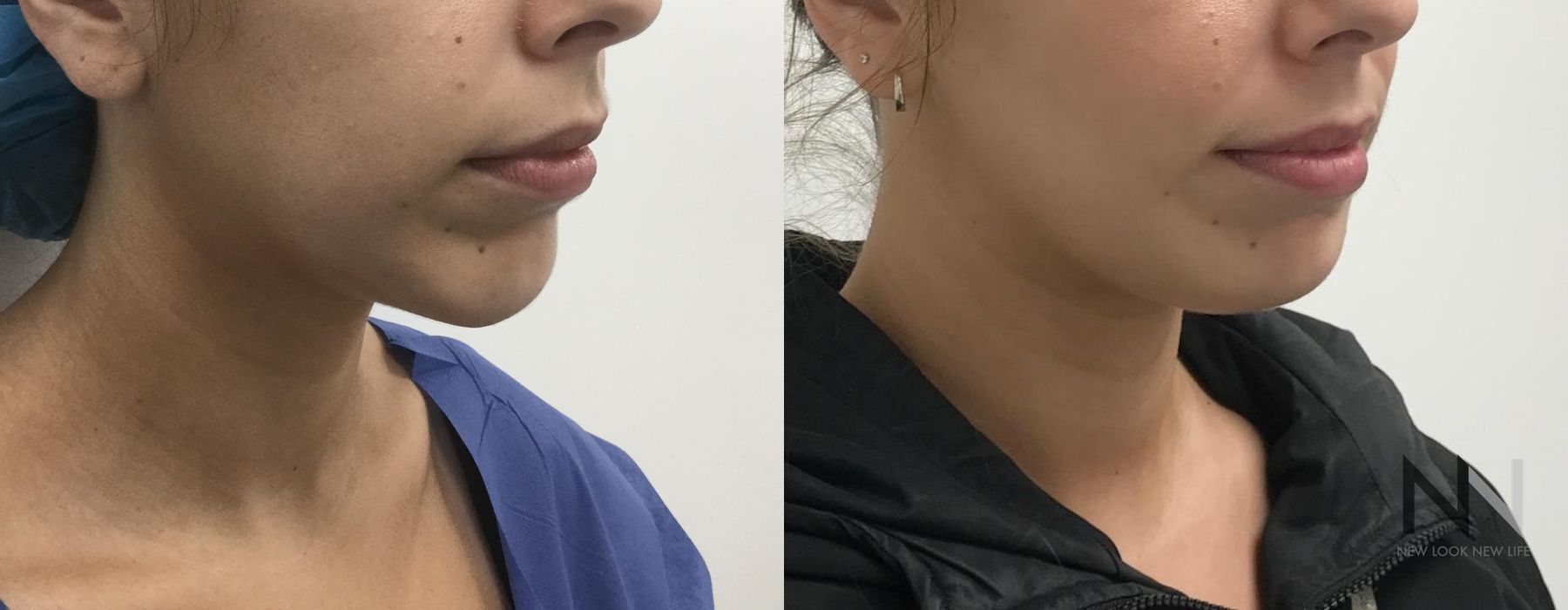 Chin Augmentation - Thumbnail 2