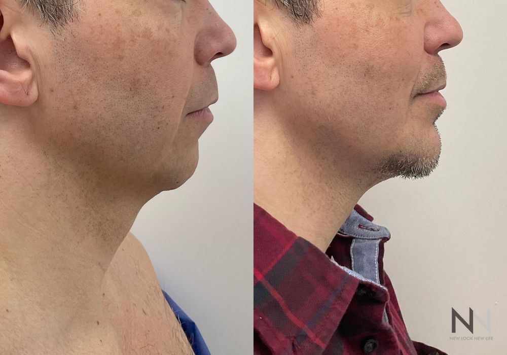 Chin Augmentation - Case 1957