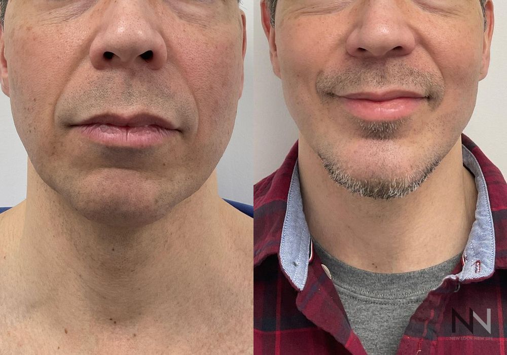 Chin Augmentation - Thumbnail 3