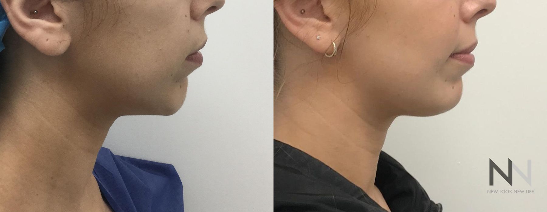 Chin Augmentation - Thumbnail 3