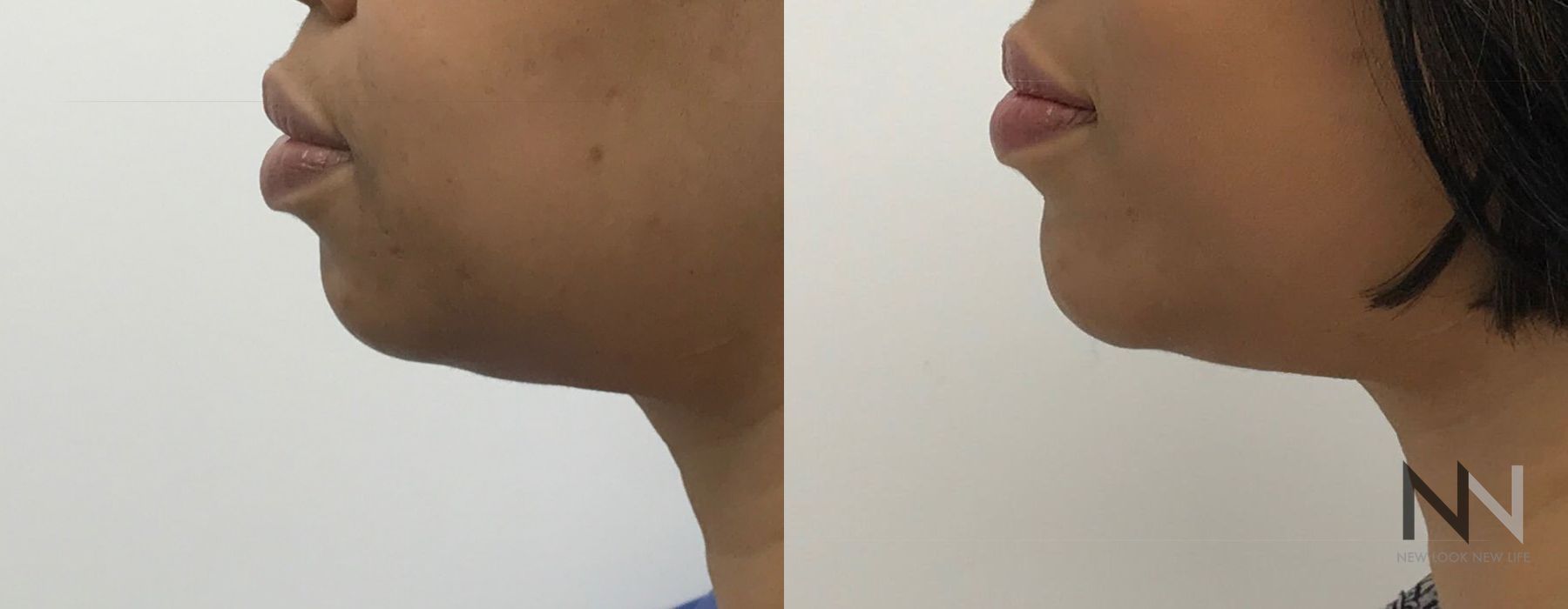 Chin Augmentation - Thumbnail 2