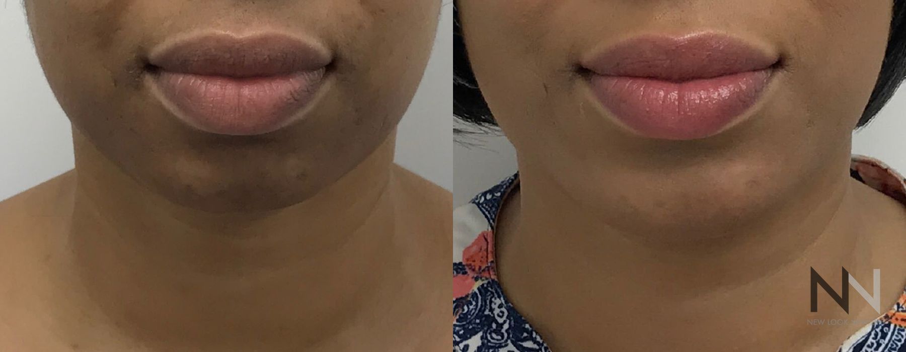 Chin Augmentation - Thumbnail 4