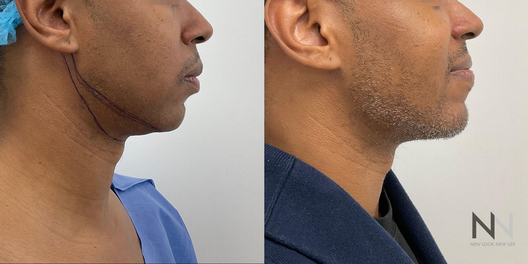 Submental liposuction showing improved jawline contour - Angle 2