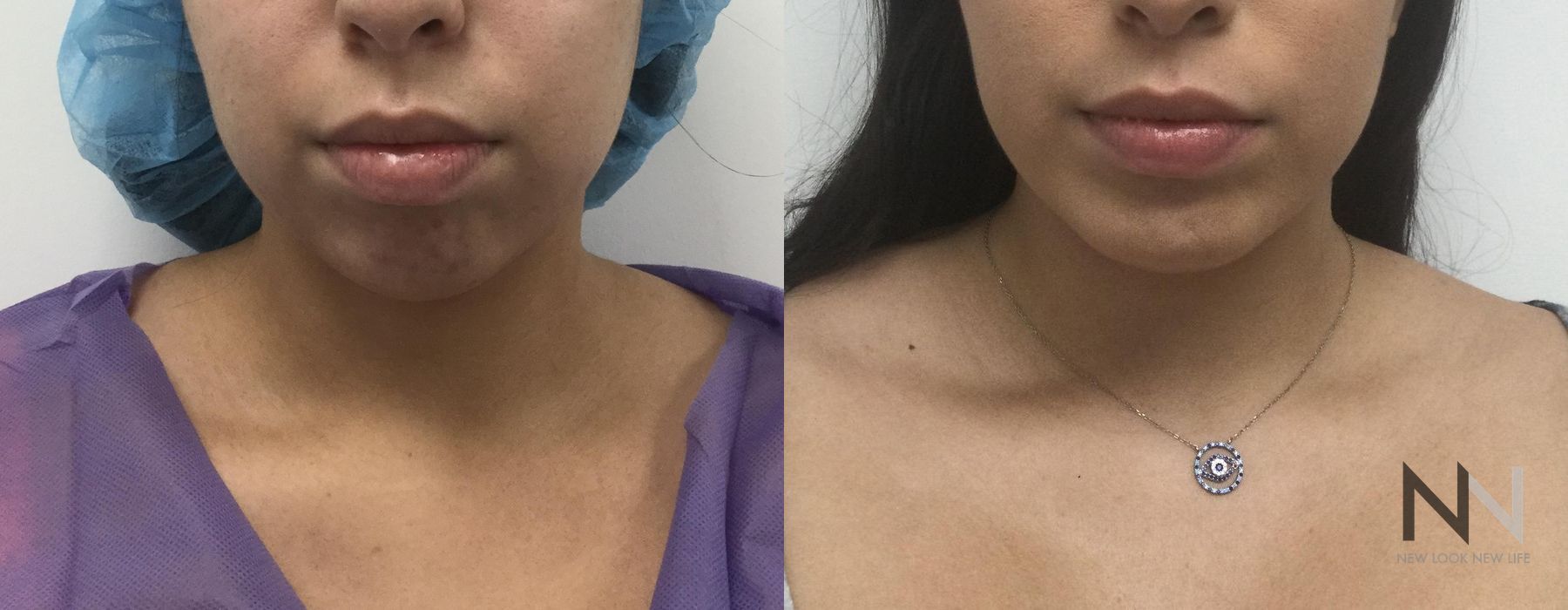 Chin Augmentation - Case 2144