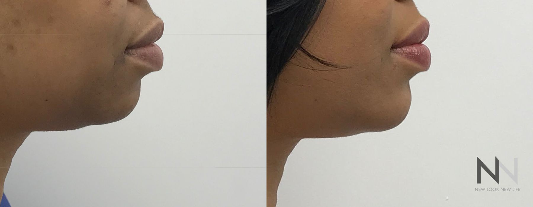 Chin Augmentation - Thumbnail 3