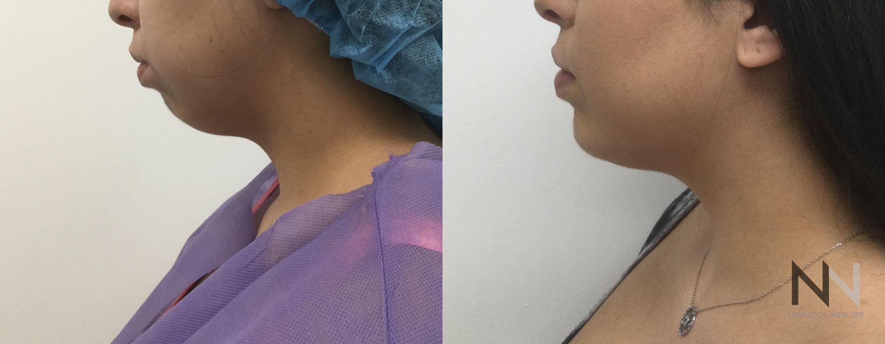 Chin Augmentation - Thumbnail 2