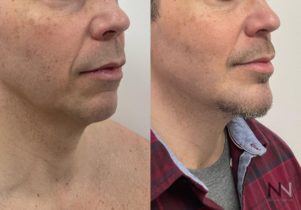 Chin Augmentation - Thumbnail 2