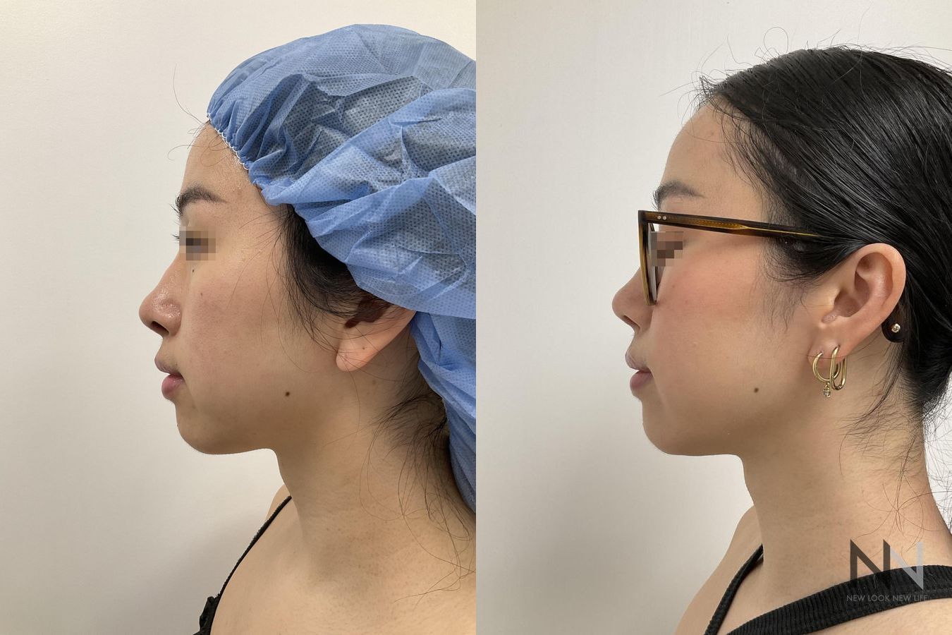 Before and after chin liposuction four months results