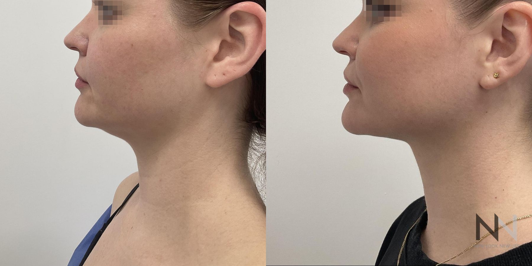 Submental liposuction showing improved jawline contour