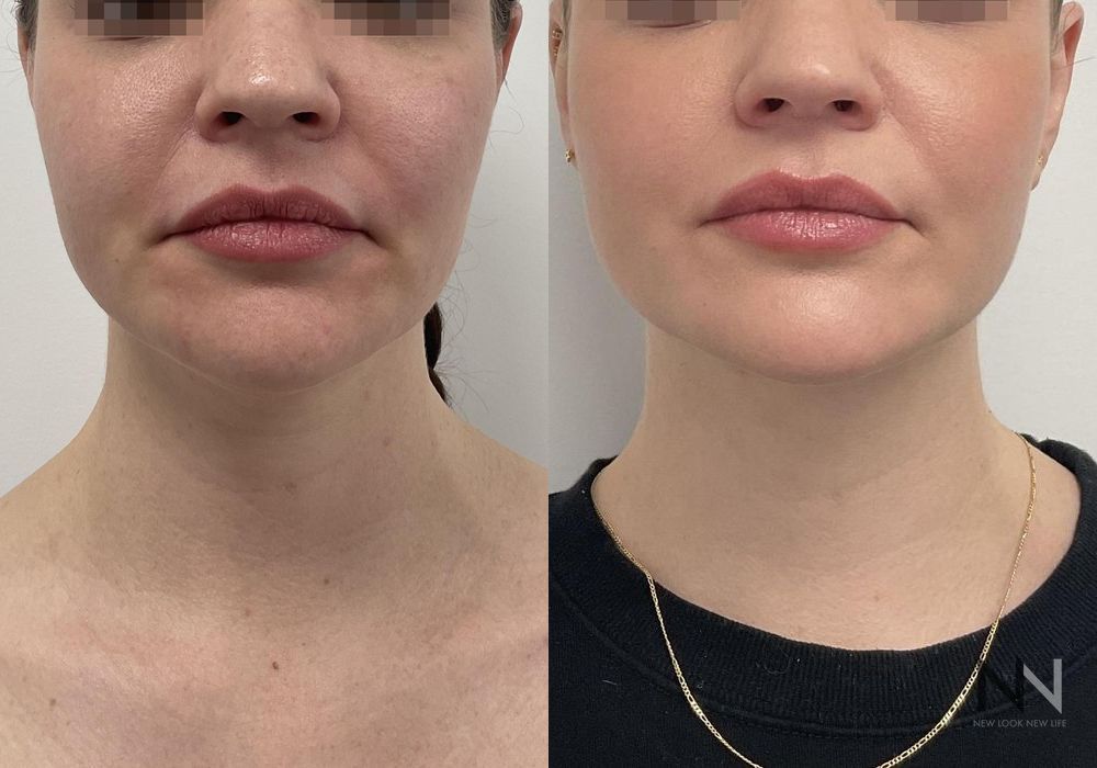 Chin Liposuction - Case 2152