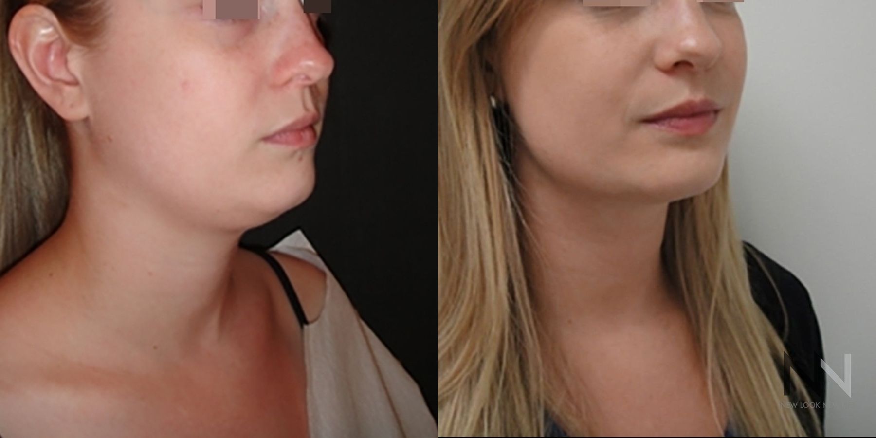 Submental liposuction showing improved jawline contour - Angle 2