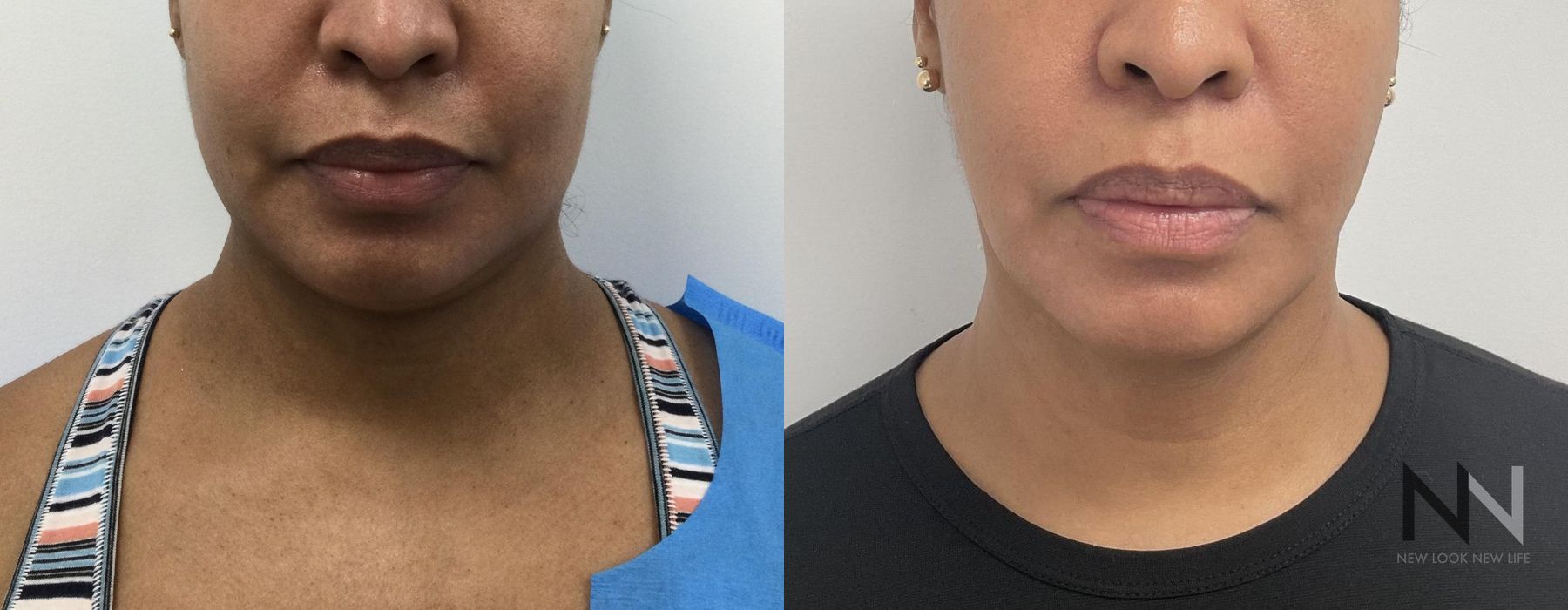 Chin Liposuction - Thumbnail 2
