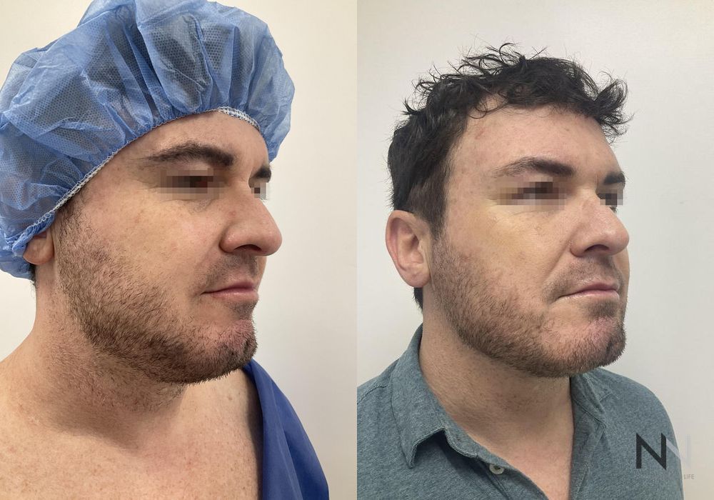 Chin Liposuction - Thumbnail 3