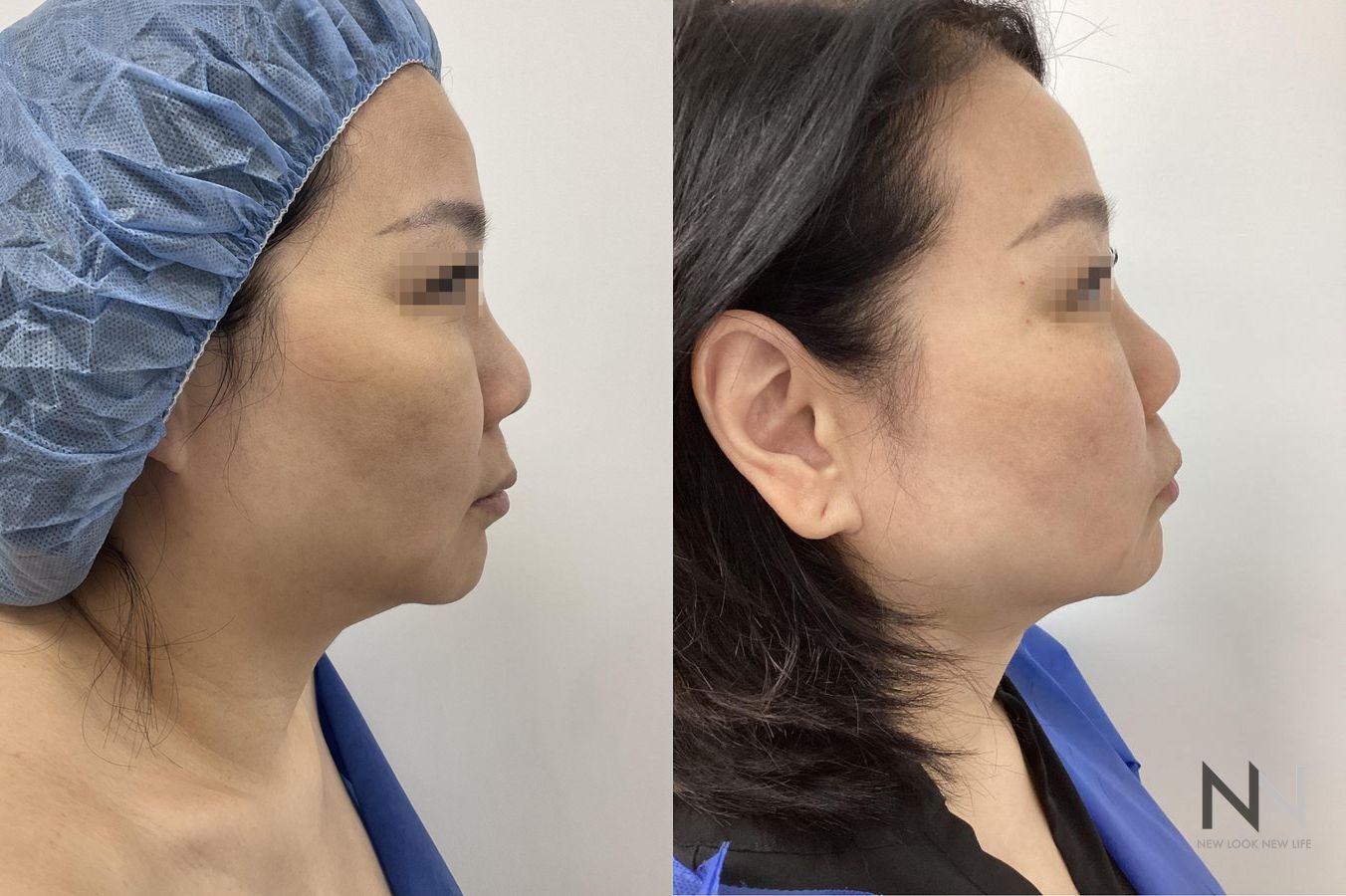 Before and after chin liposuction four months results - Angle 5