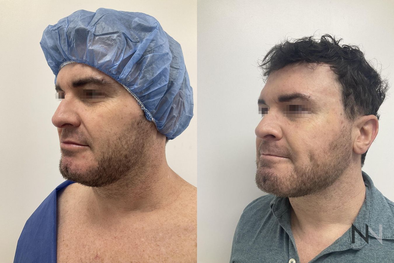 Submental liposuction showing improved jawline contour - Angle 4