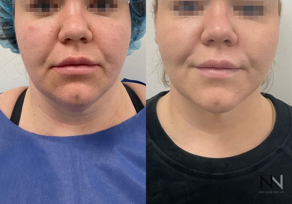 Chin Liposuction - Case 2155
