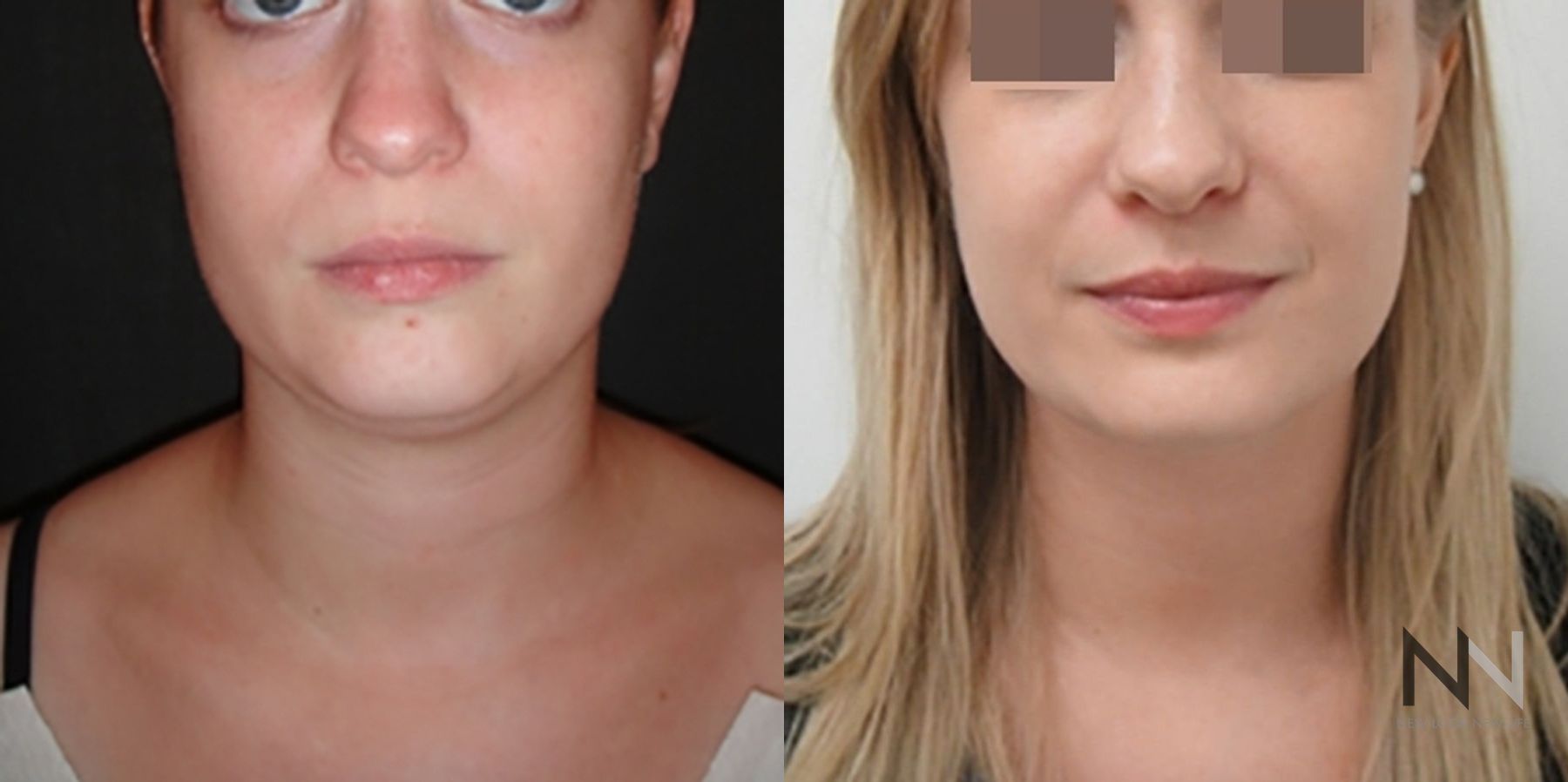 Submental liposuction showing improved jawline contour - Angle 5
