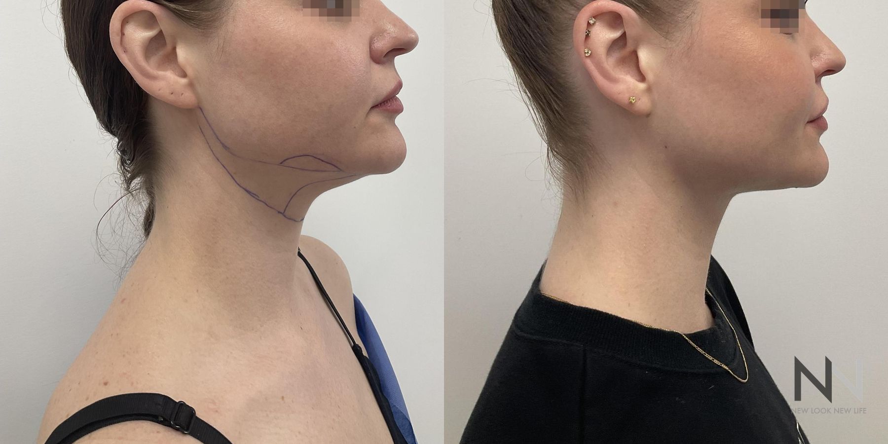 Submental liposuction showing improved jawline contour - Angle 3
