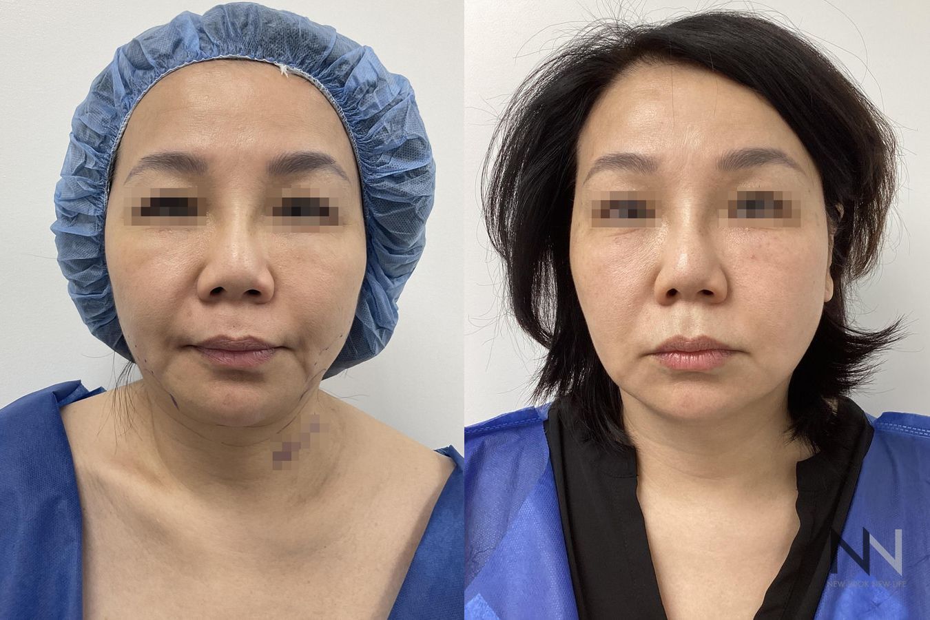 Before and after chin liposuction four months results - Angle 3