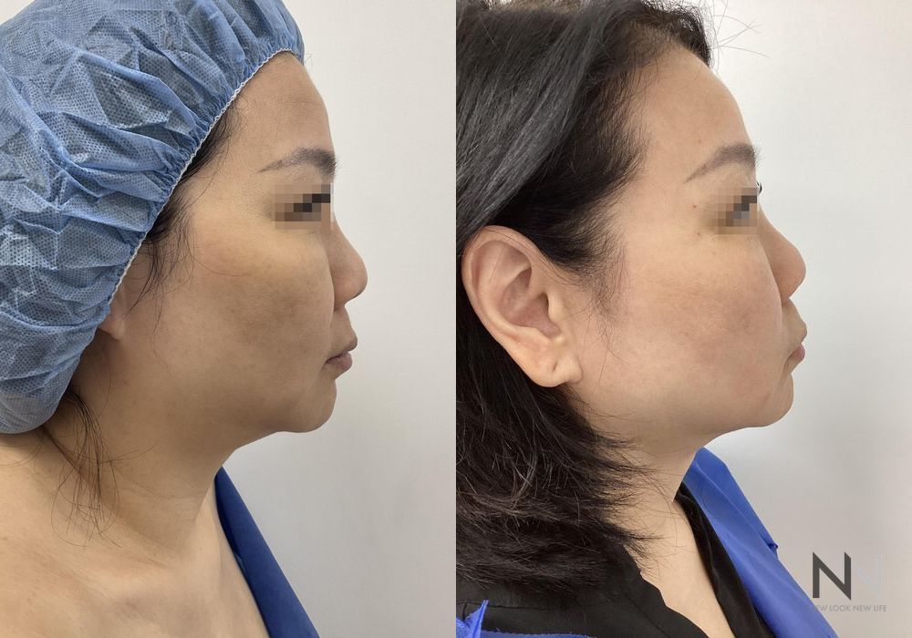 Chin Liposuction - Thumbnail 5