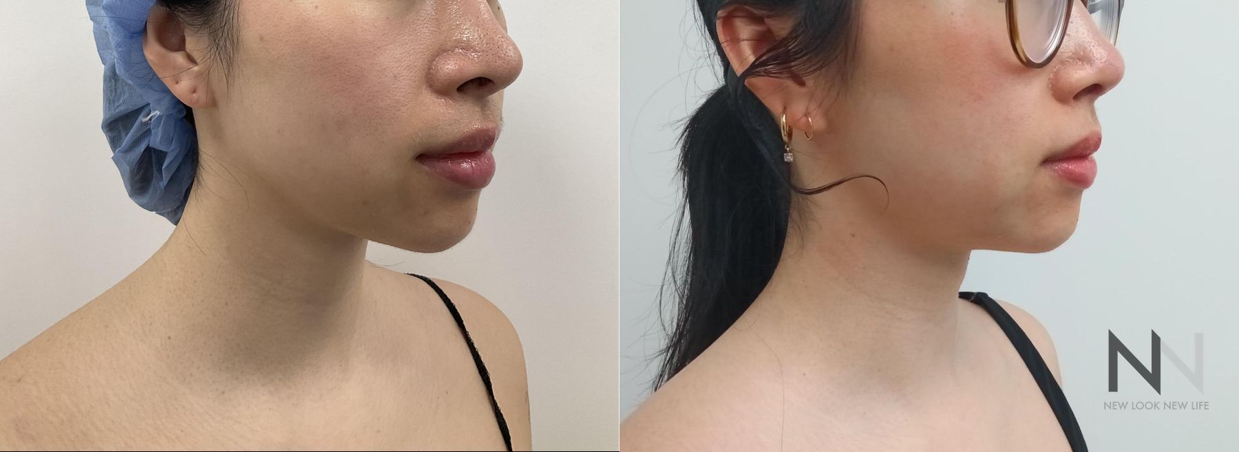 Before and after chin liposuction four months results - Angle 4