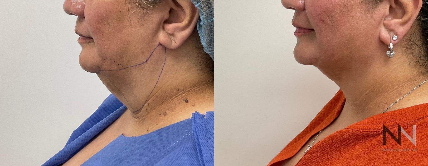 Chin Liposuction - Thumbnail 2