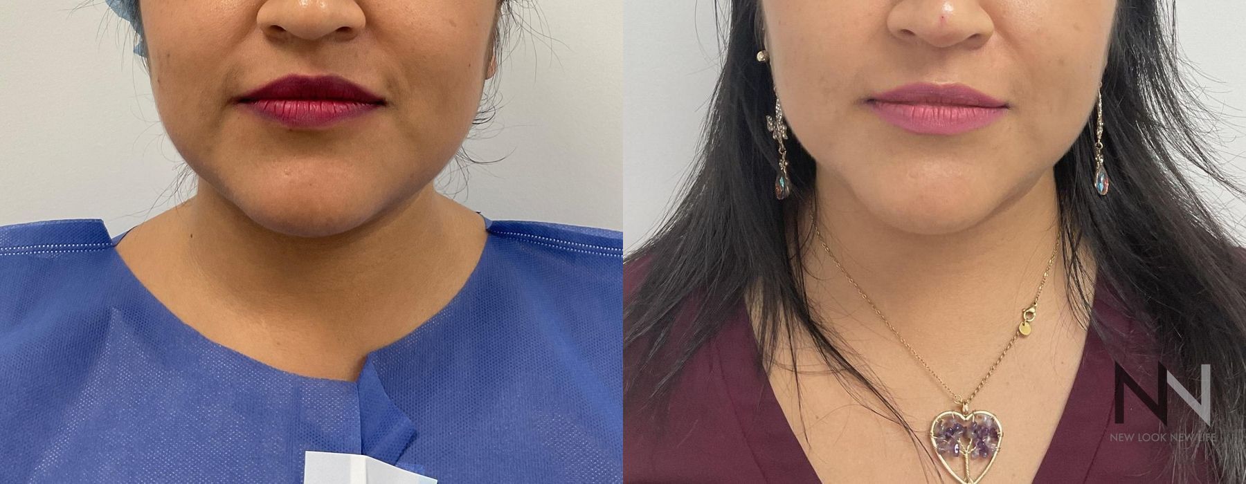 Chin Liposuction - Thumbnail 2