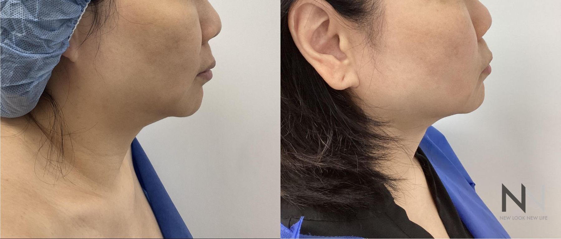 Before and after chin liposuction four months results - Angle 5