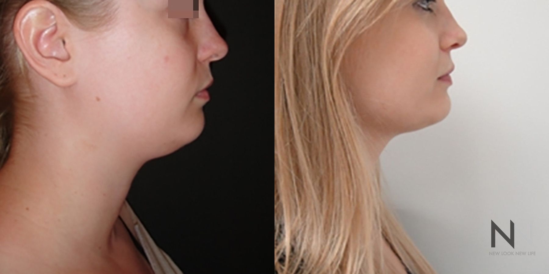 Submental liposuction showing improved jawline contour