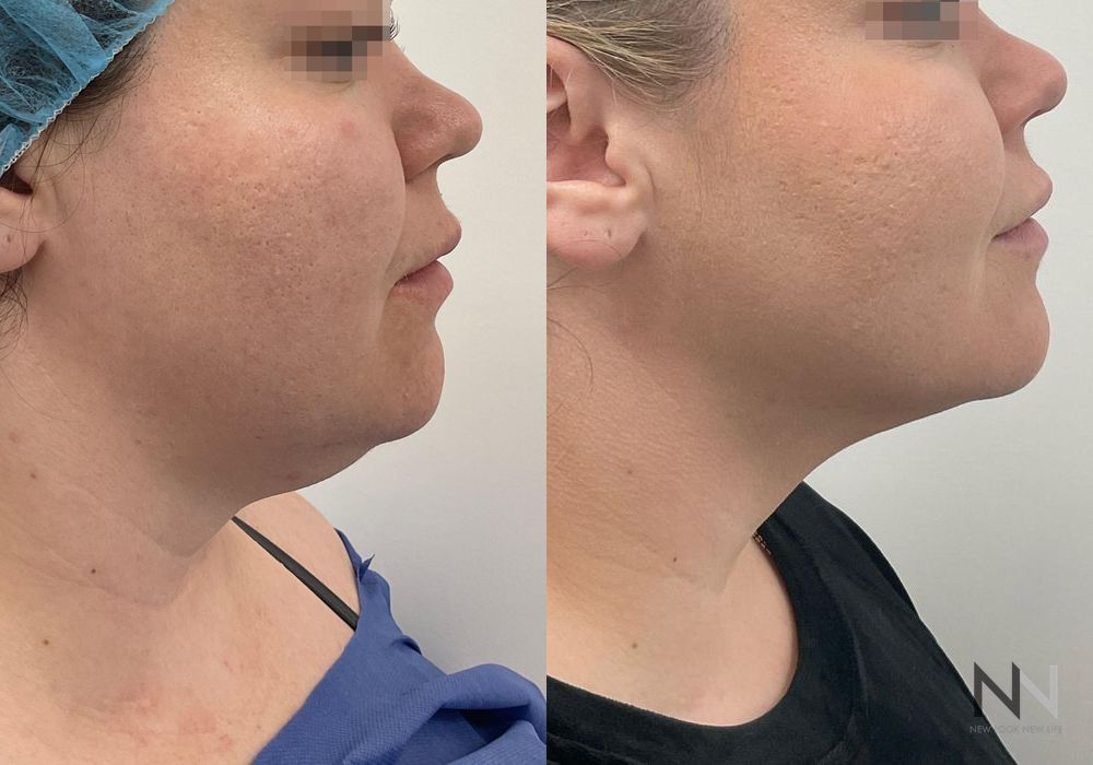 Chin Liposuction - Case 201
