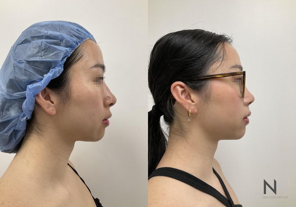 Chin Liposuction - Thumbnail 5