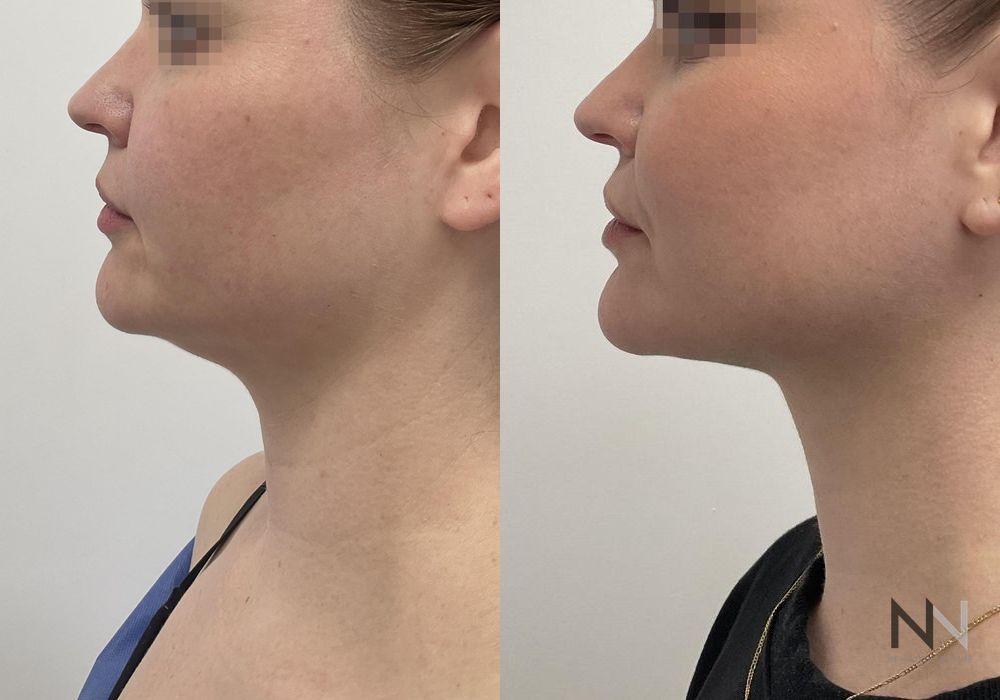 Chin Liposuction - Thumbnail 3