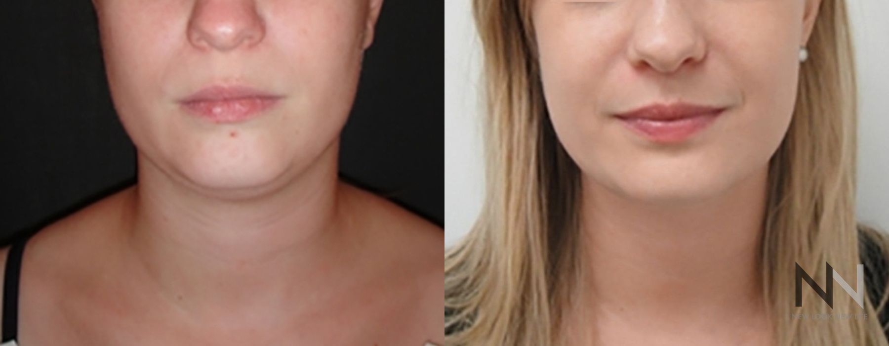 Chin Liposuction - Case 1616