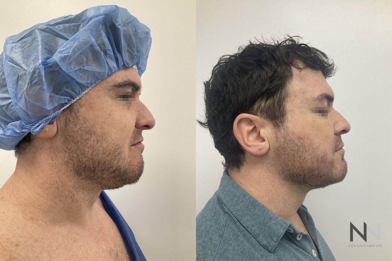 Submental liposuction showing improved jawline contour