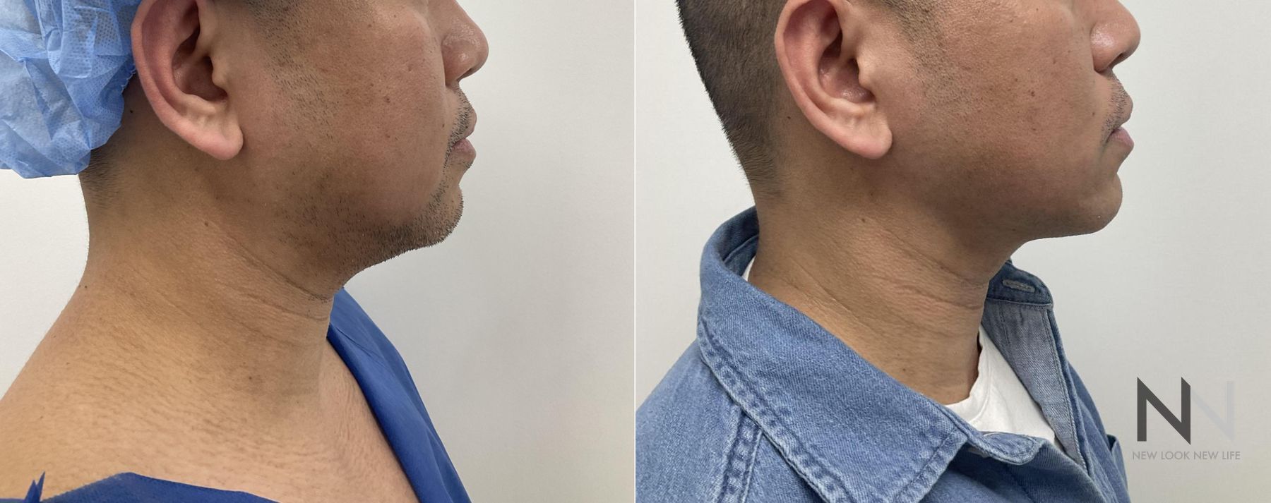 Submental liposuction showing improved jawline contour - Angle 5