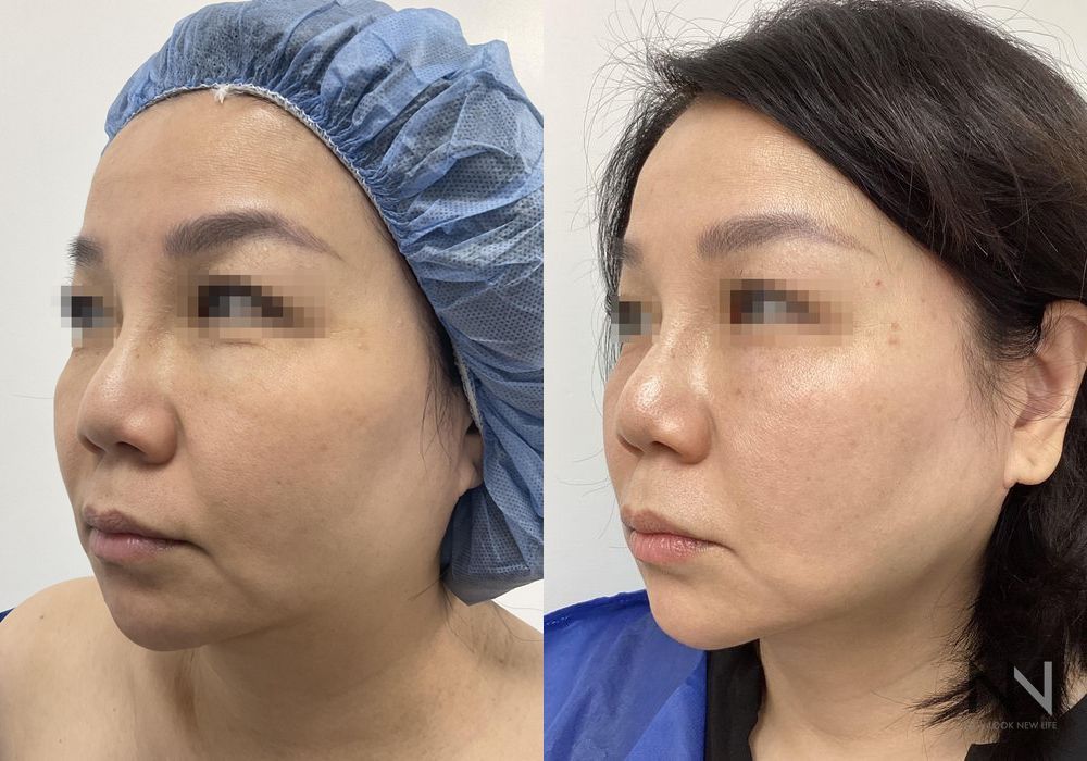 Chin Liposuction - Thumbnail 2