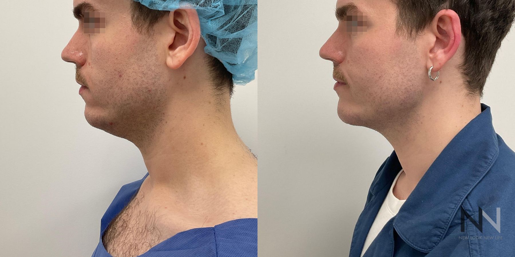 Submental liposuction showing improved jawline contour