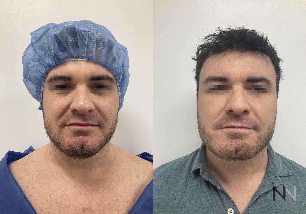 Chin Liposuction - Case 2156