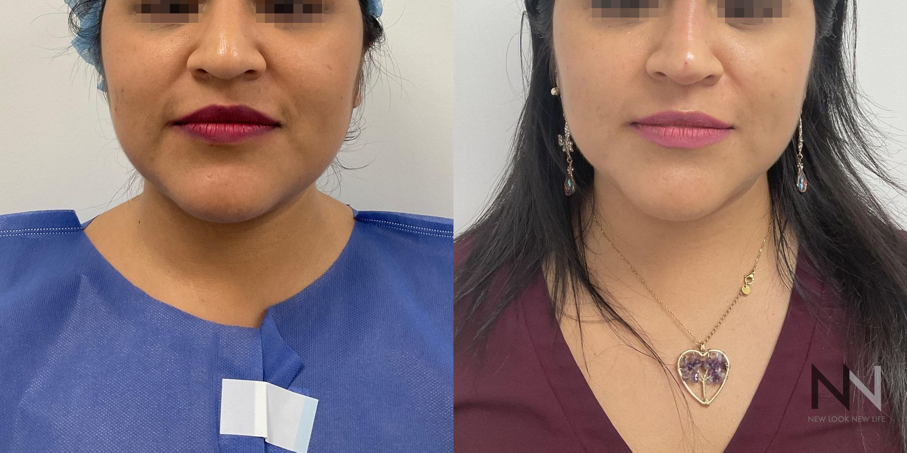 Submental liposuction showing improved jawline contour - Angle 3